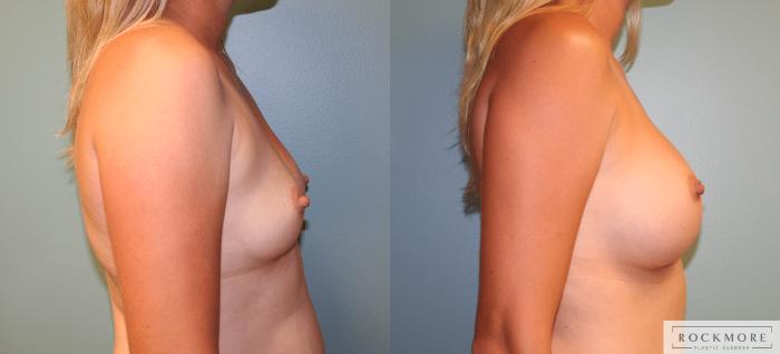 Before & After Breast Augmentation Case 171 View #3 View in Albany & Latham, New York