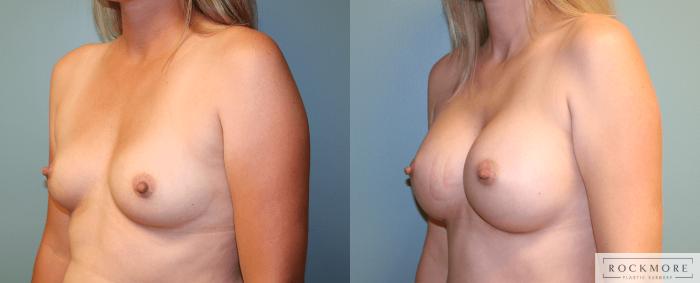 Before & After Breast Augmentation Case 171 View #4 View in Albany & Latham, New York