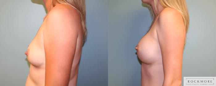 Before & After Breast Augmentation Case 171 View #5 View in Albany & Latham, New York