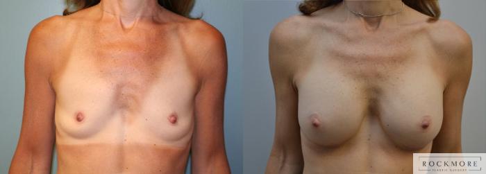 Before & After Breast Augmentation Case 175 View #1 View in Albany & Latham, New York