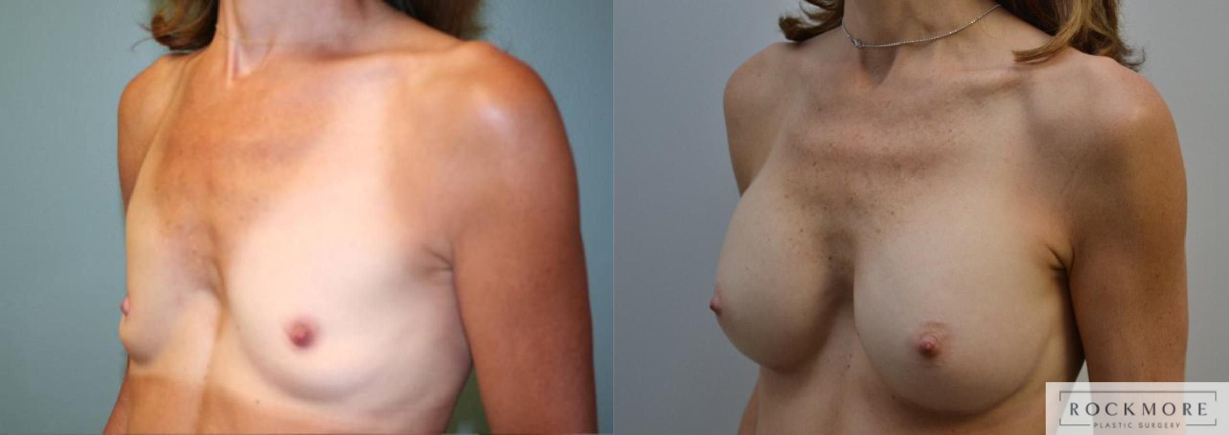 Before & After Breast Augmentation Case 175 View #2 View in Albany & Latham, New York