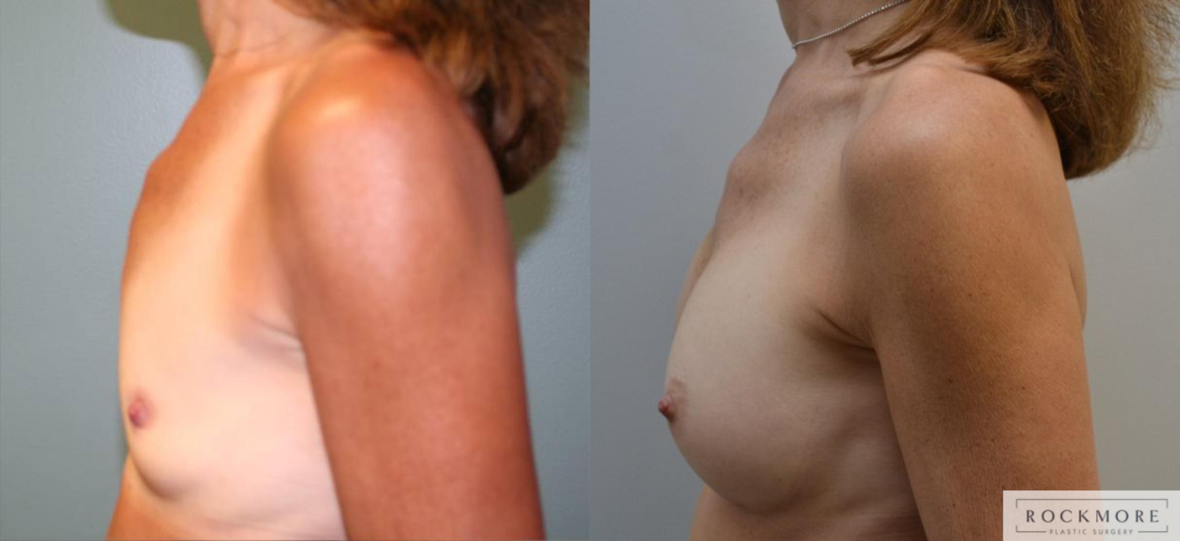 Before & After Breast Augmentation Case 175 View #3 View in Albany & Latham, New York