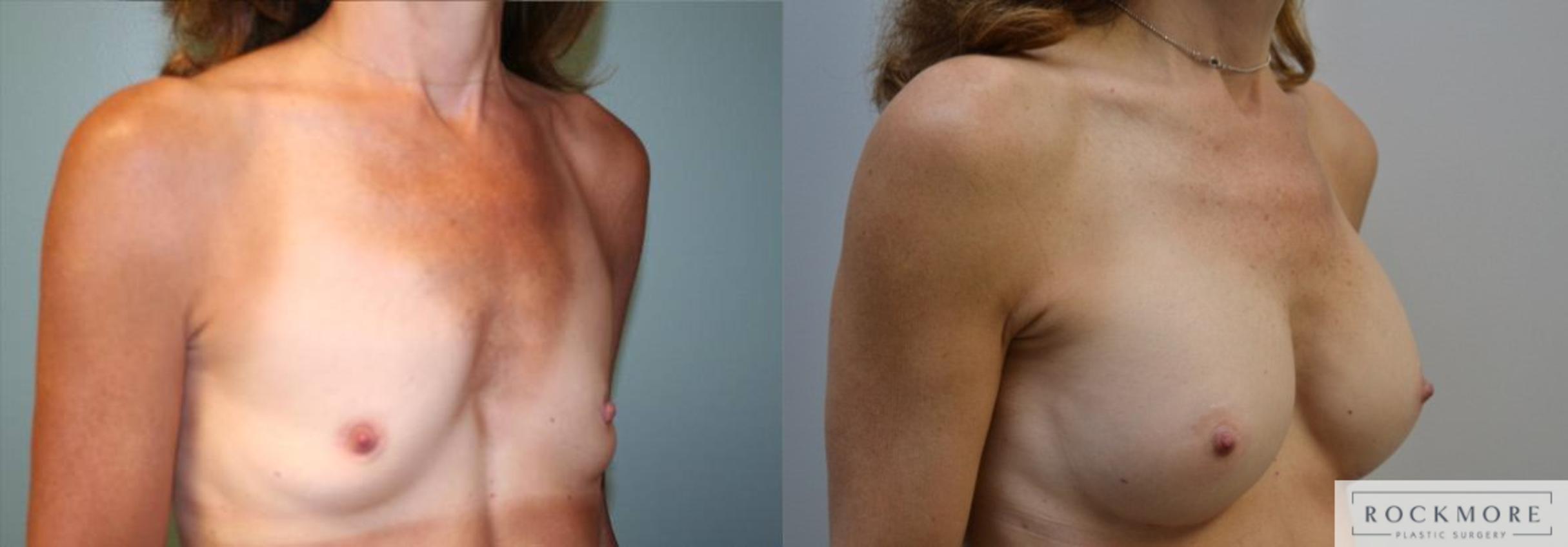 Before & After Breast Augmentation Case 175 View #4 View in Albany & Latham, New York