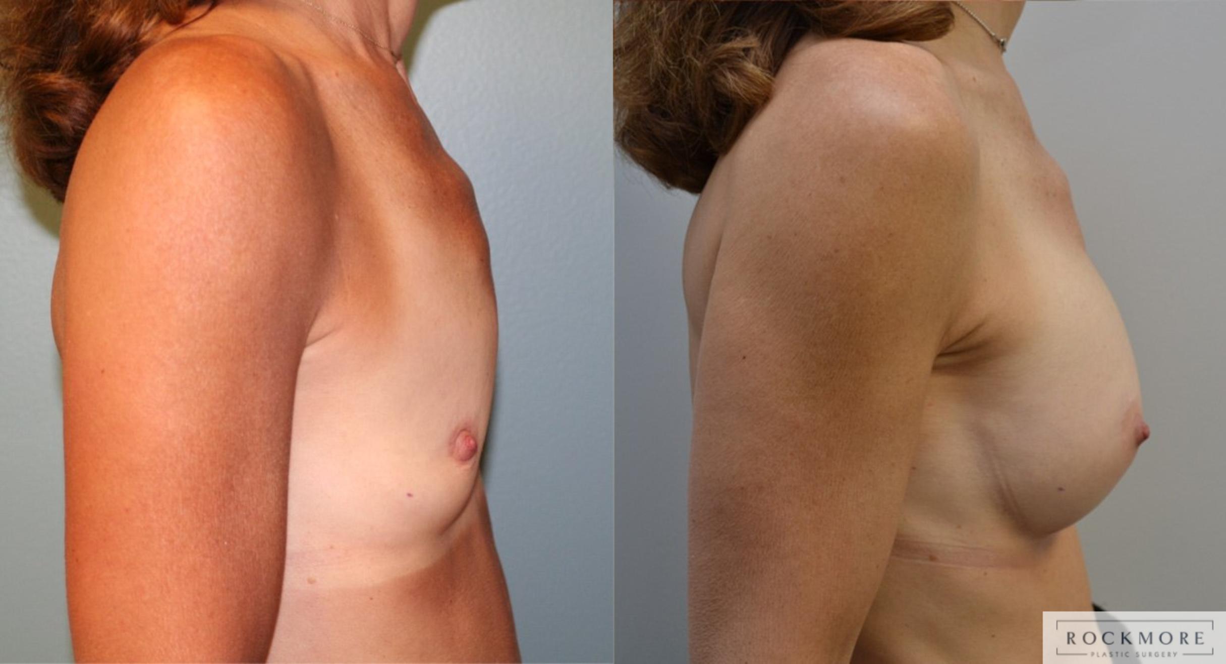 Before & After Breast Augmentation Case 175 View #5 View in Albany & Latham, New York