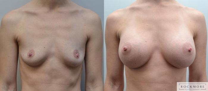 Before & After Breast Augmentation Case 185 View #1 View in Albany & Latham, New York