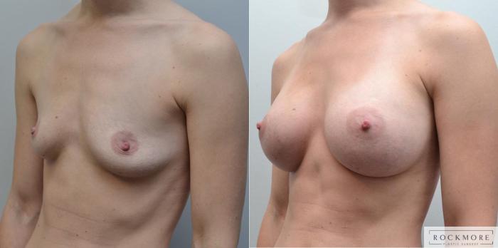 Before & After Breast Augmentation Case 185 View #2 View in Albany & Latham, New York