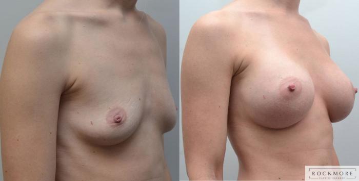 Before & After Breast Augmentation Case 185 View #3 View in Albany & Latham, New York