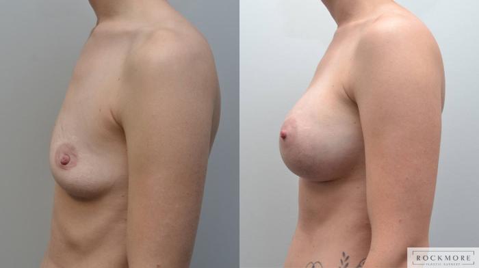 Before & After Breast Augmentation Case 185 View #4 View in Albany & Latham, New York