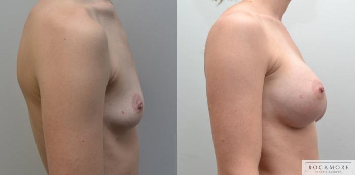 Before & After Breast Augmentation Case 185 View #5 View in Albany & Latham, New York
