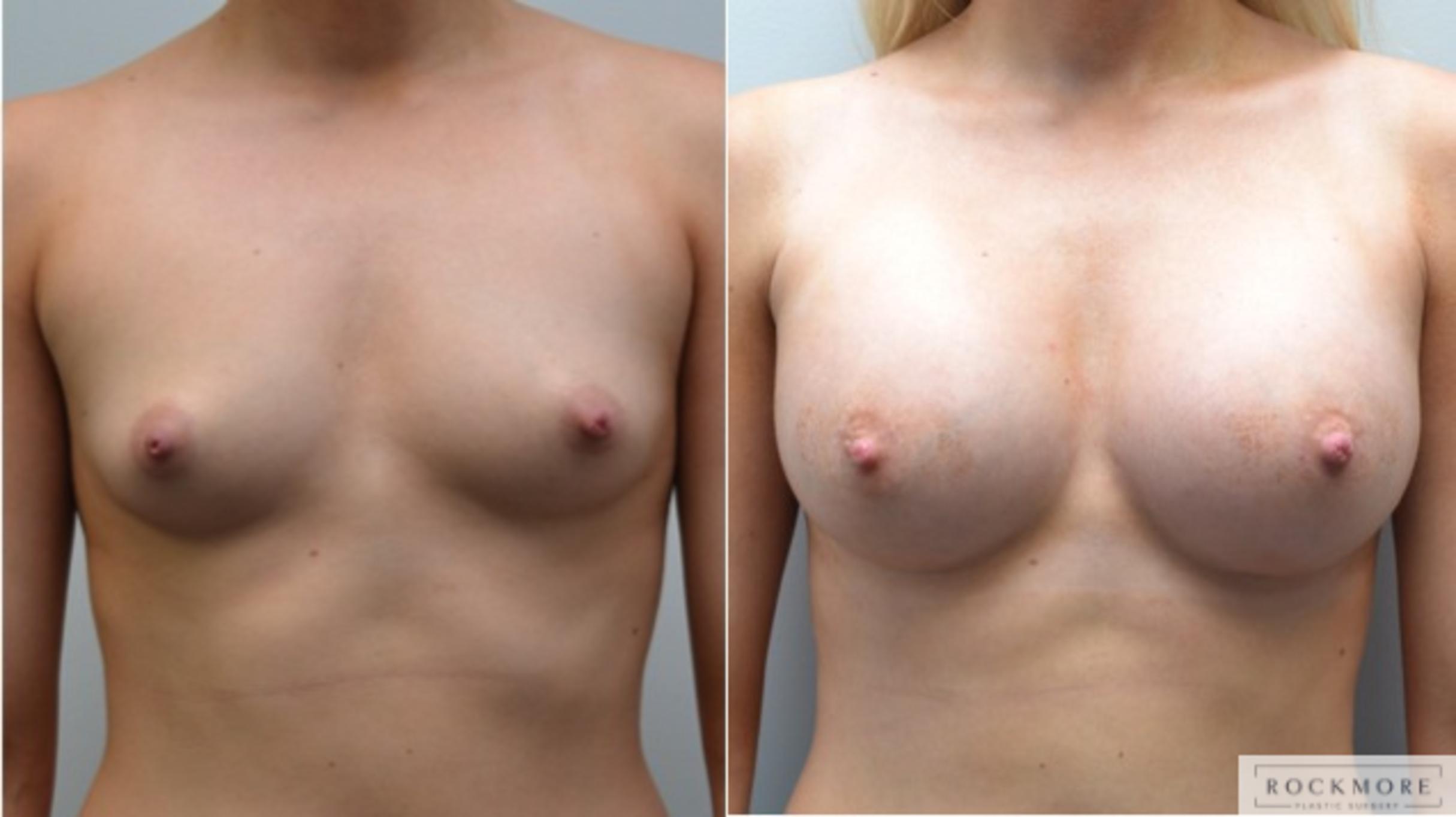 Before & After Breast Augmentation Case 209 View #1 View in Albany & Latham, New York
