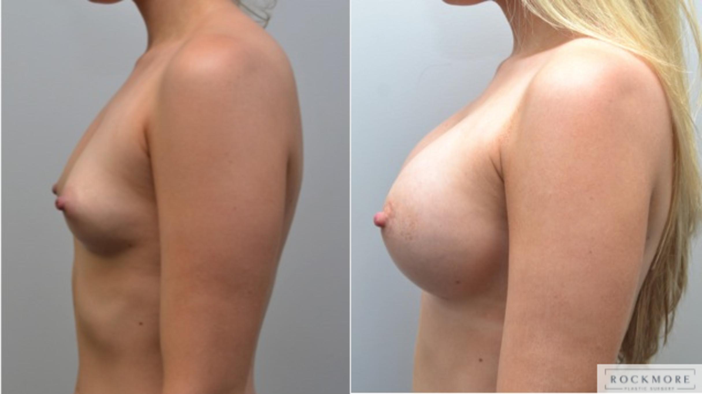 Before & After Breast Augmentation Case 209 View #2 View in Albany & Latham, New York
