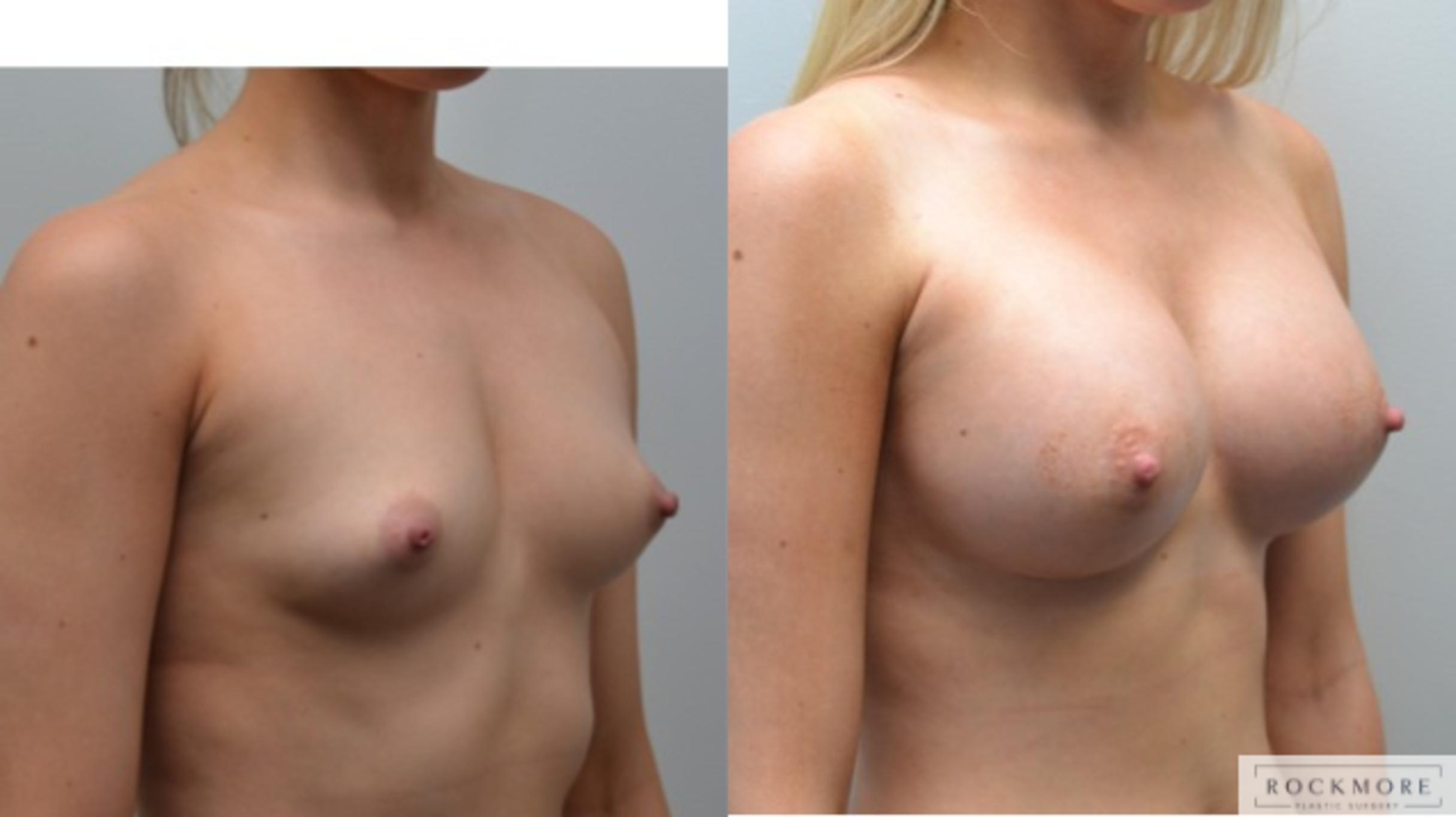 Before & After Breast Augmentation Case 209 View #3 View in Albany & Latham, New York