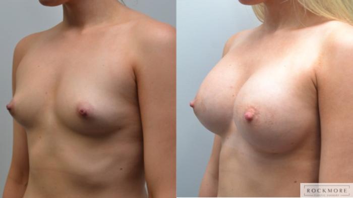 Before & After Breast Augmentation Case 209 View #4 View in Albany & Latham, New York