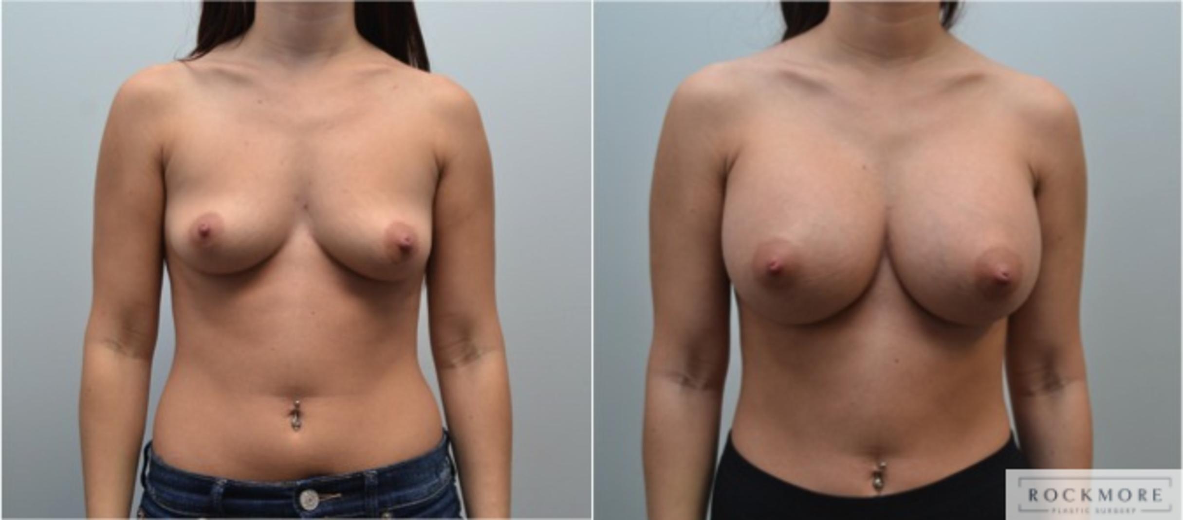 Before & After Breast Augmentation Case 222 View #1 View in Albany & Latham, New York