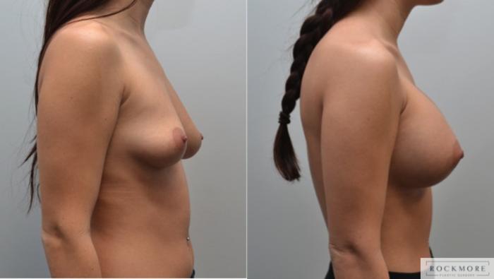 Before & After Breast Augmentation Case 222 View #2 View in Albany & Latham, New York