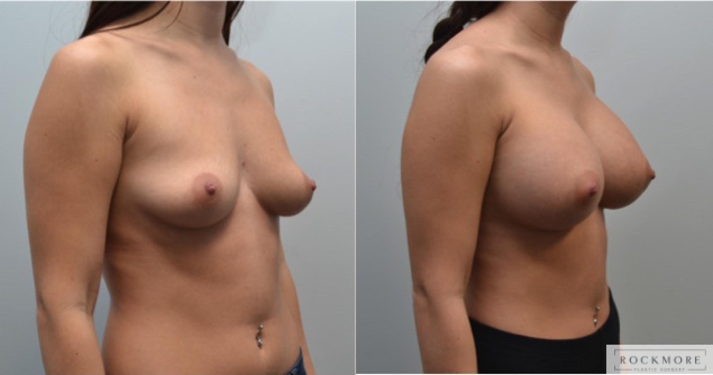 Before & After Breast Augmentation Case 222 View #3 View in Albany & Latham, New York