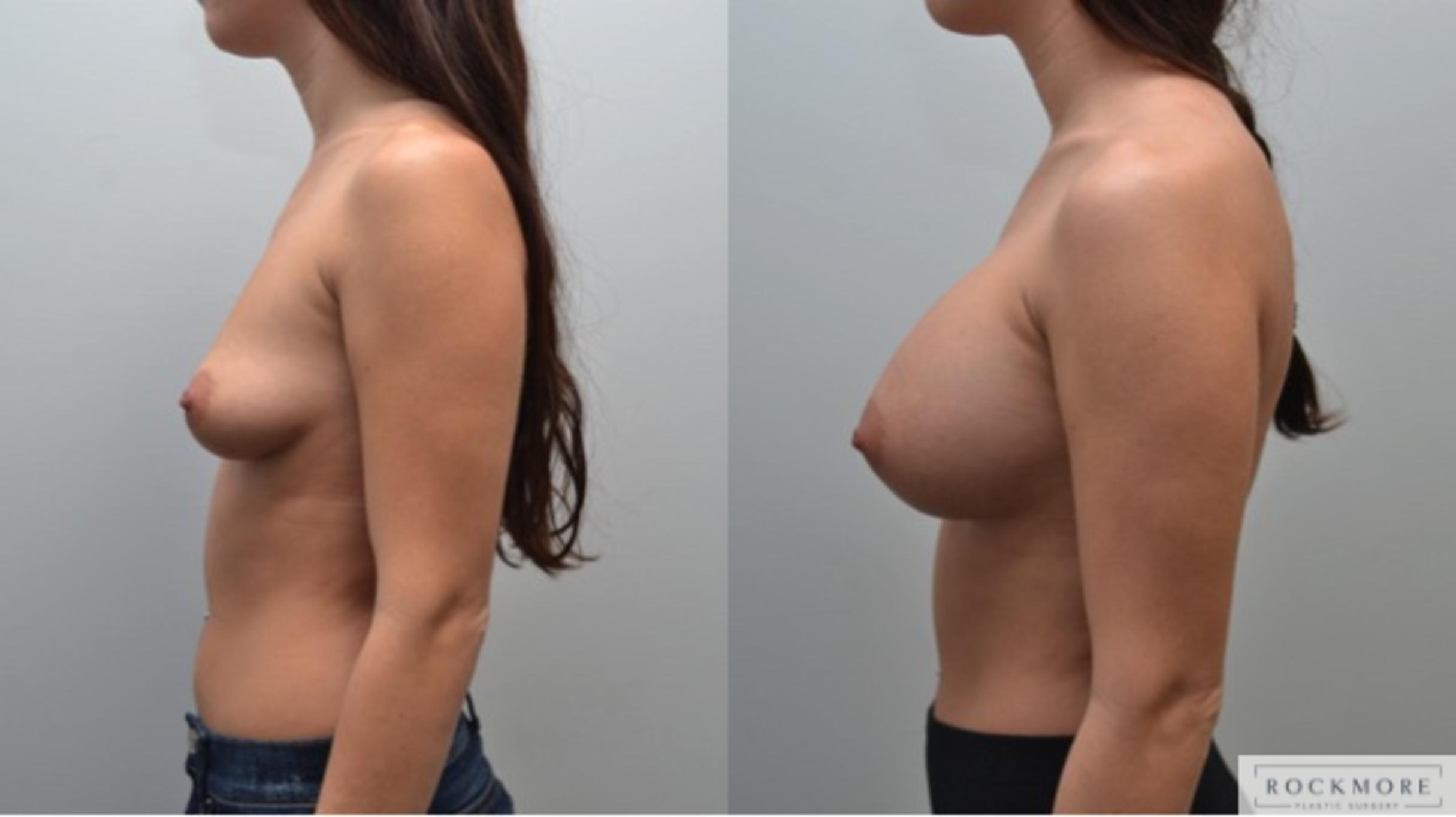 Before & After Breast Augmentation Case 222 View #4 View in Albany & Latham, New York