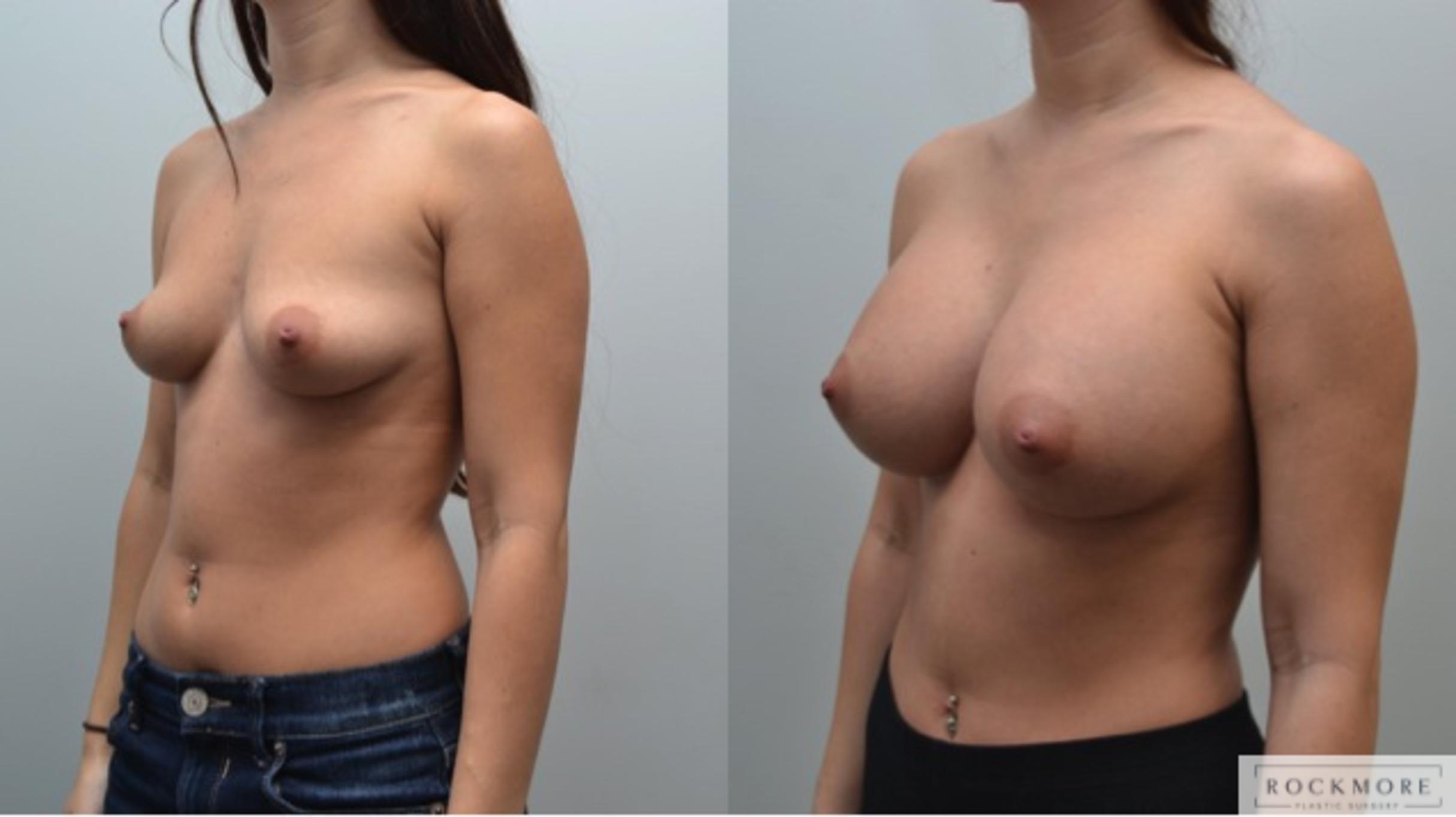 Before & After Breast Augmentation Case 222 View #5 View in Albany & Latham, New York
