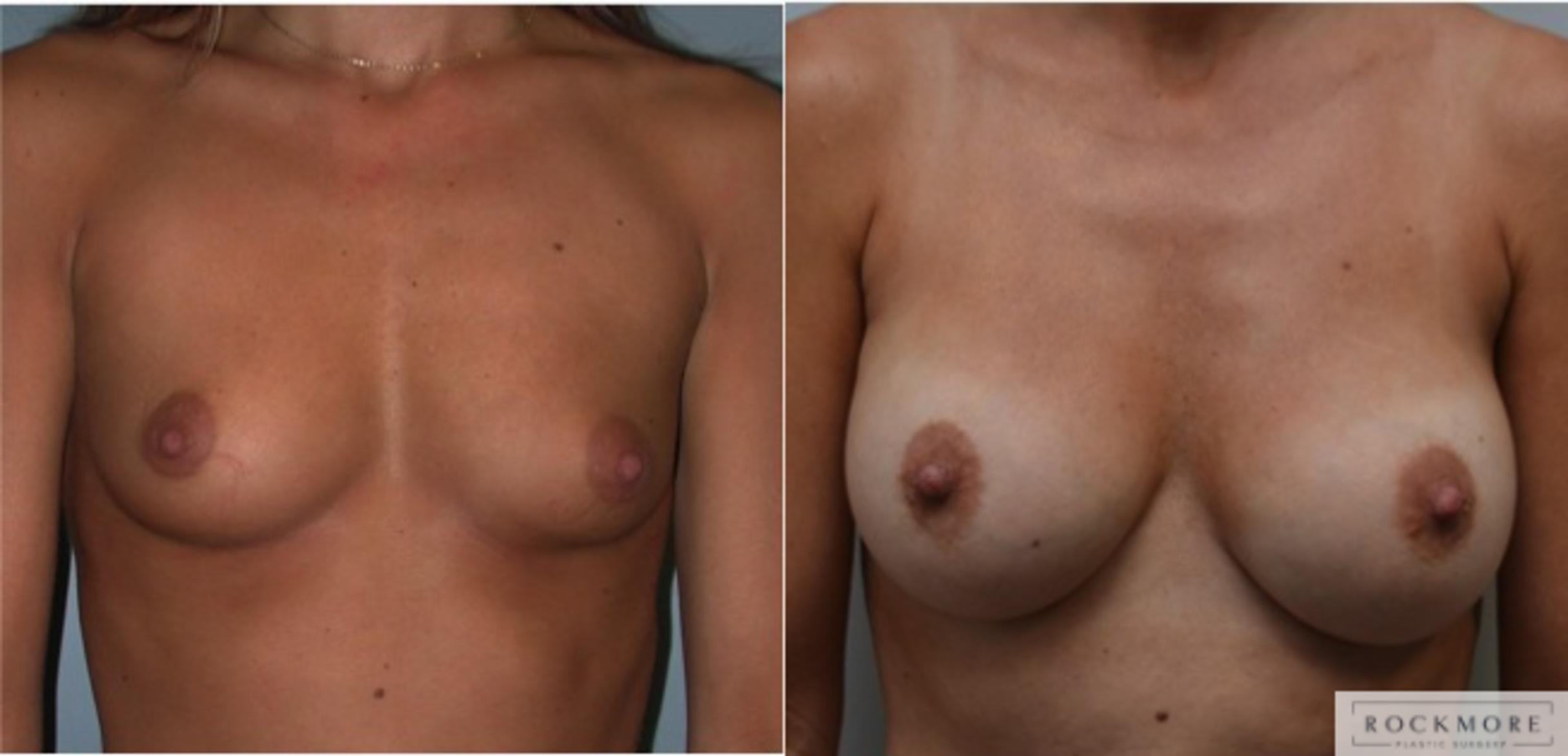 Before & After Breast Augmentation Case 224 View #1 View in Albany & Latham, New York