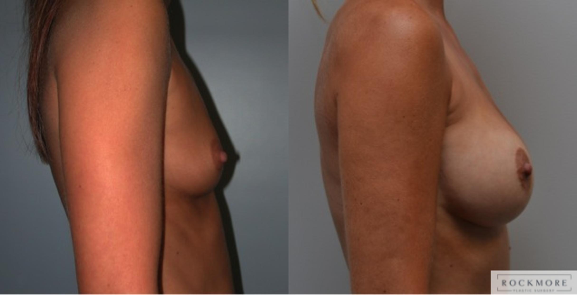 Before & After Breast Augmentation Case 224 View #2 View in Albany & Latham, New York