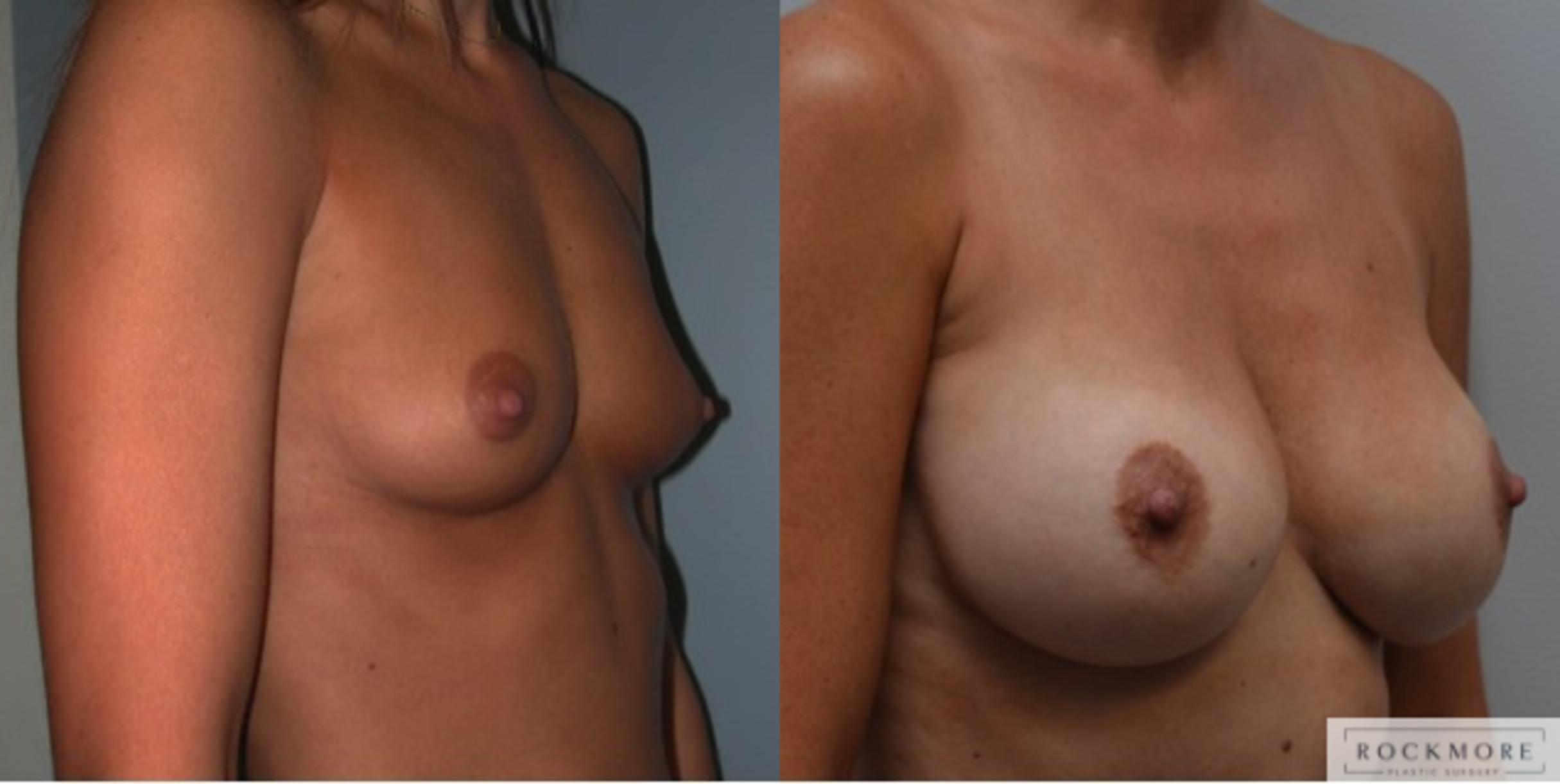 Before & After Breast Augmentation Case 224 View #3 View in Albany & Latham, New York