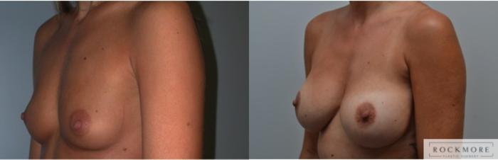 Before & After Breast Augmentation Case 224 View #4 View in Albany & Latham, New York