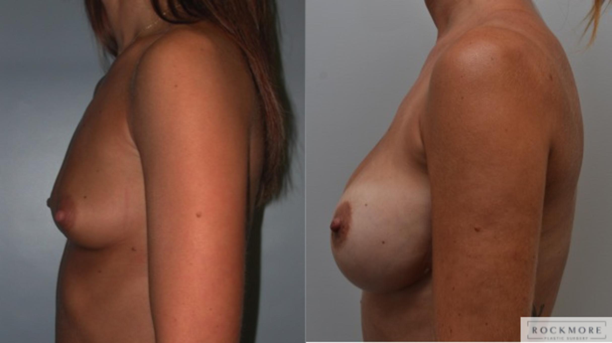Before & After Breast Augmentation Case 224 View #5 View in Albany & Latham, New York