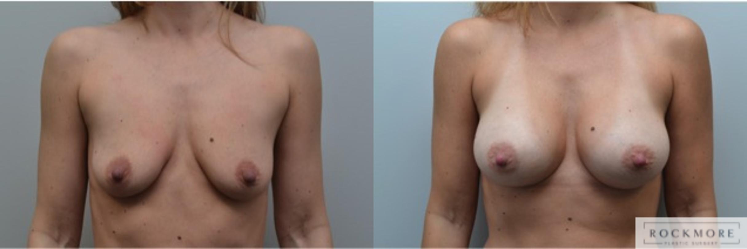 Before & After Breast Augmentation Case 227 View #1 View in Albany & Latham, New York