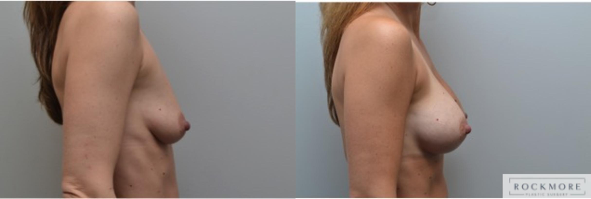 Before & After Breast Augmentation Case 227 View #2 View in Albany & Latham, New York