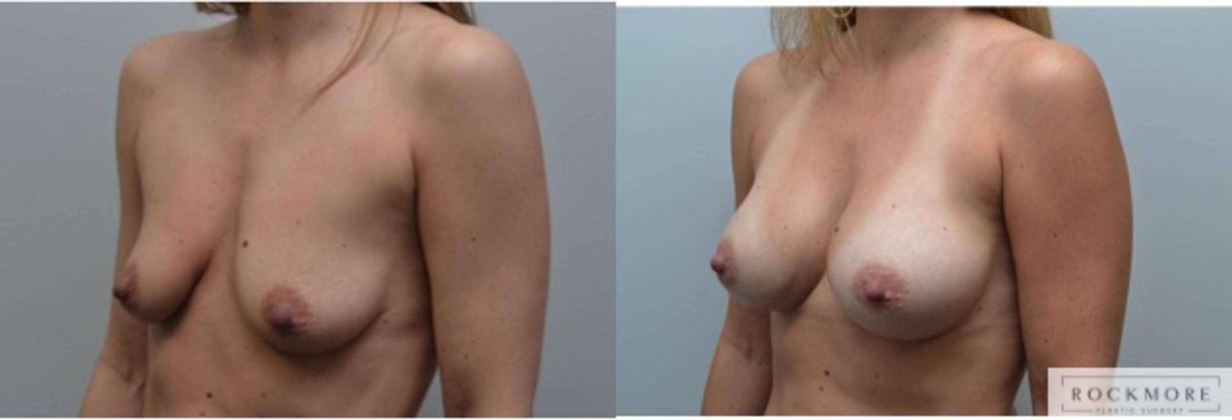 Before & After Breast Augmentation Case 227 View #3 View in Albany & Latham, New York