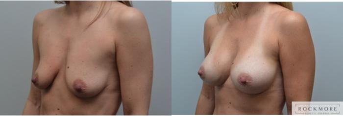 Before & After Breast Augmentation Case 227 View #3 View in Albany & Latham, New York