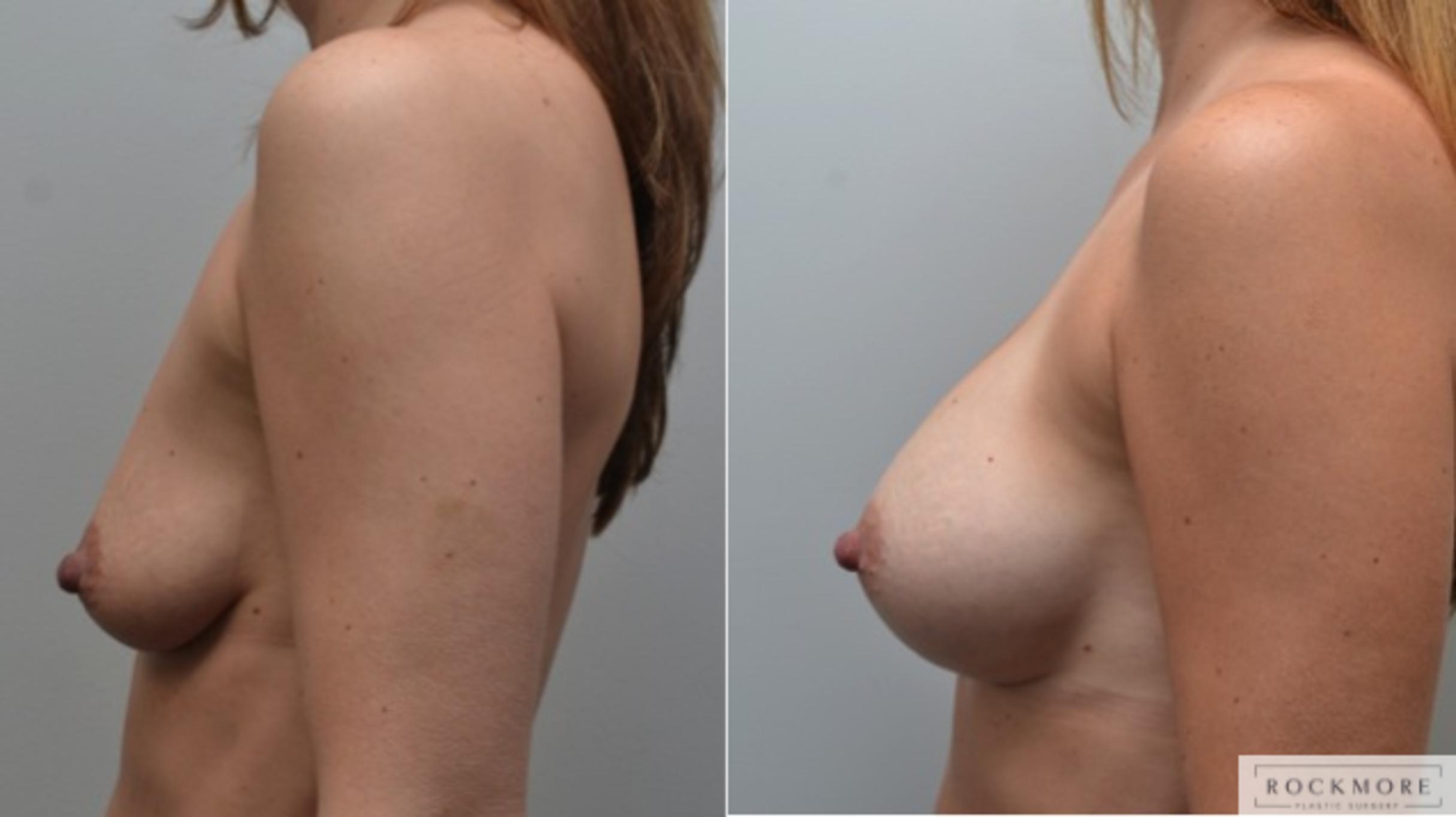 Before & After Breast Augmentation Case 227 View #4 View in Albany & Latham, New York