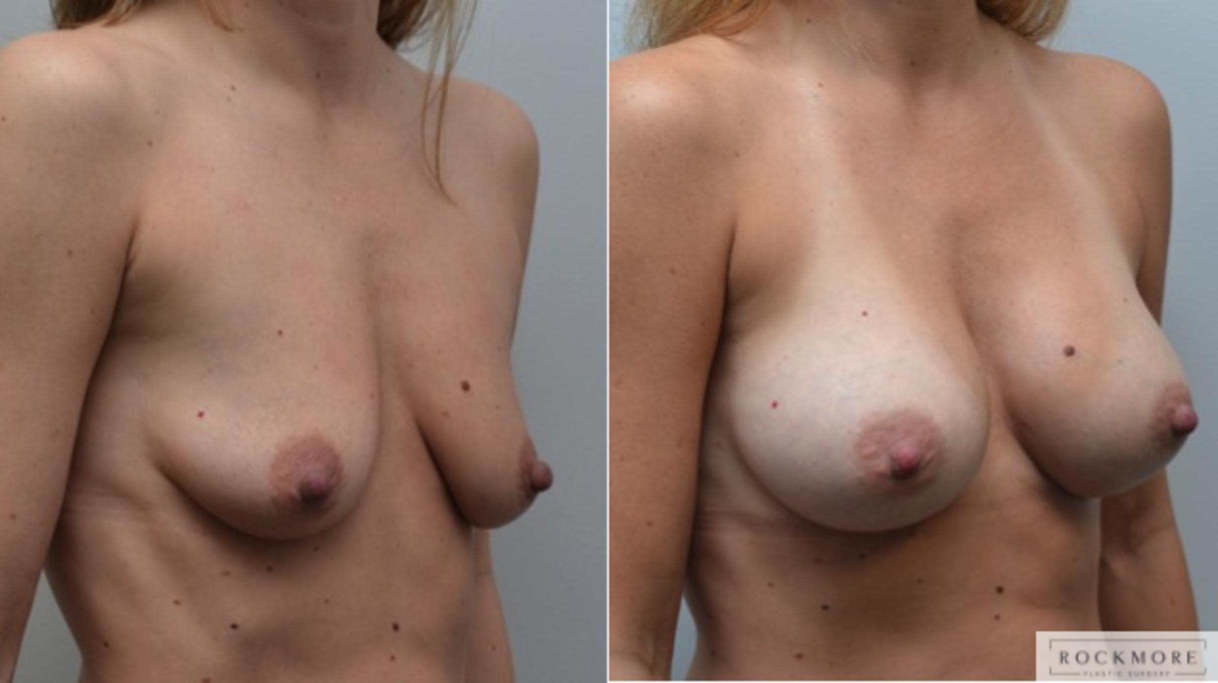Before & After Breast Augmentation Case 227 View #5 View in Albany & Latham, New York