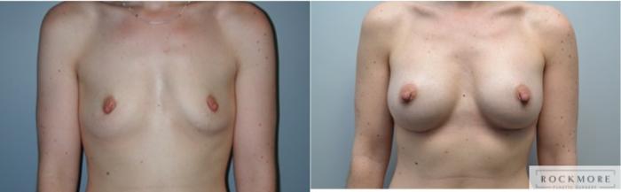 Before & After Breast Augmentation Case 232 View #1 View in Albany & Latham, New York