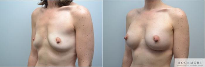 Before & After Breast Augmentation Case 232 View #3 View in Albany & Latham, New York