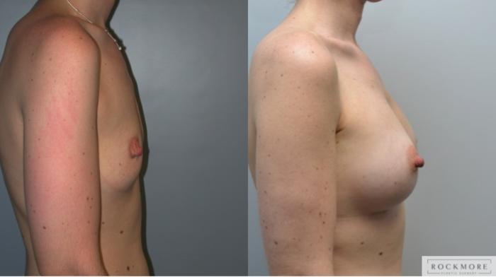 Before & After Breast Augmentation Case 232 View #4 View in Albany & Latham, New York