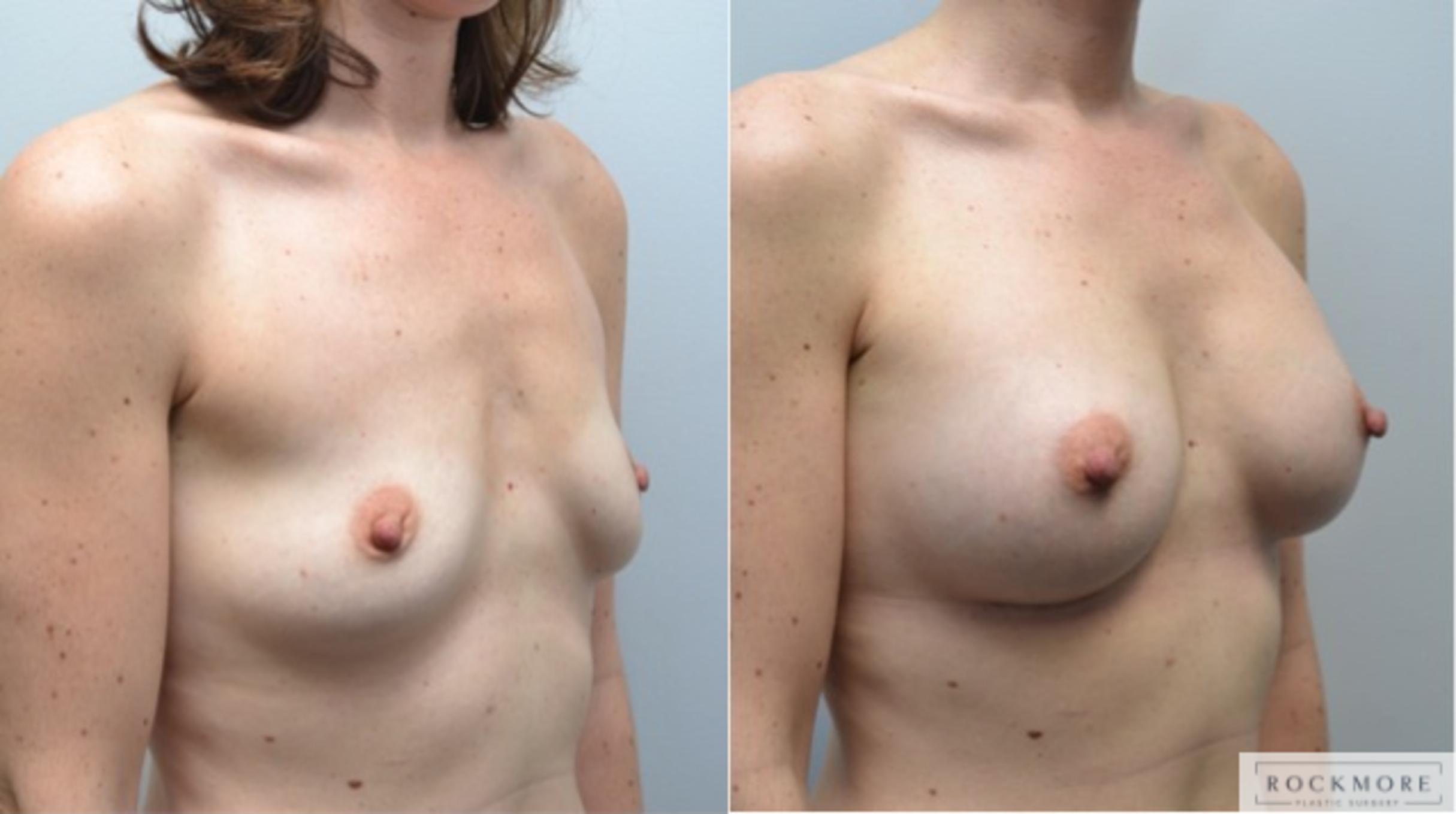 Before & After Breast Augmentation Case 232 View #5 View in Albany & Latham, New York
