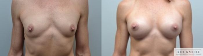 Before & After Breast Augmentation Case 243 View #1 View in Albany & Latham, New York
