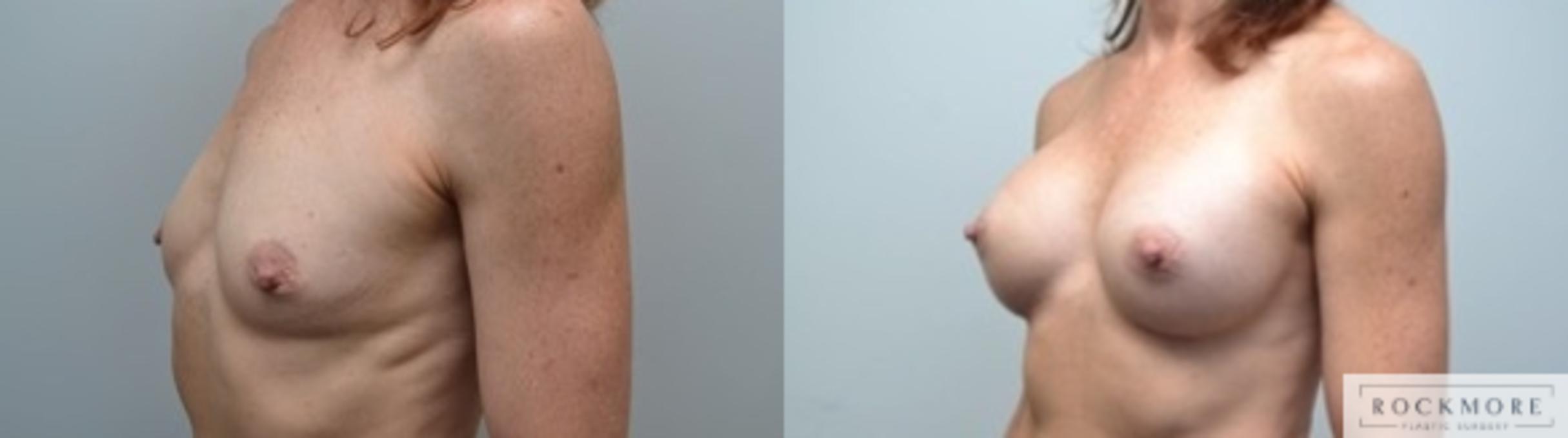 Before & After Breast Augmentation Case 243 View #2 View in Albany & Latham, New York