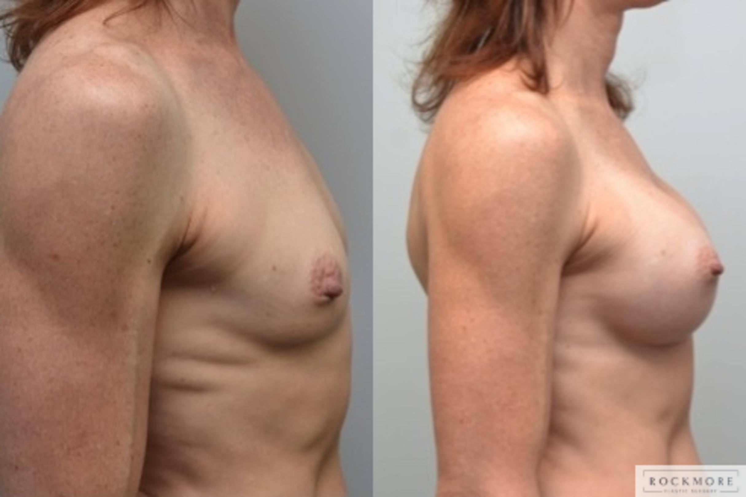 Before & After Breast Augmentation Case 243 View #3 View in Albany & Latham, New York