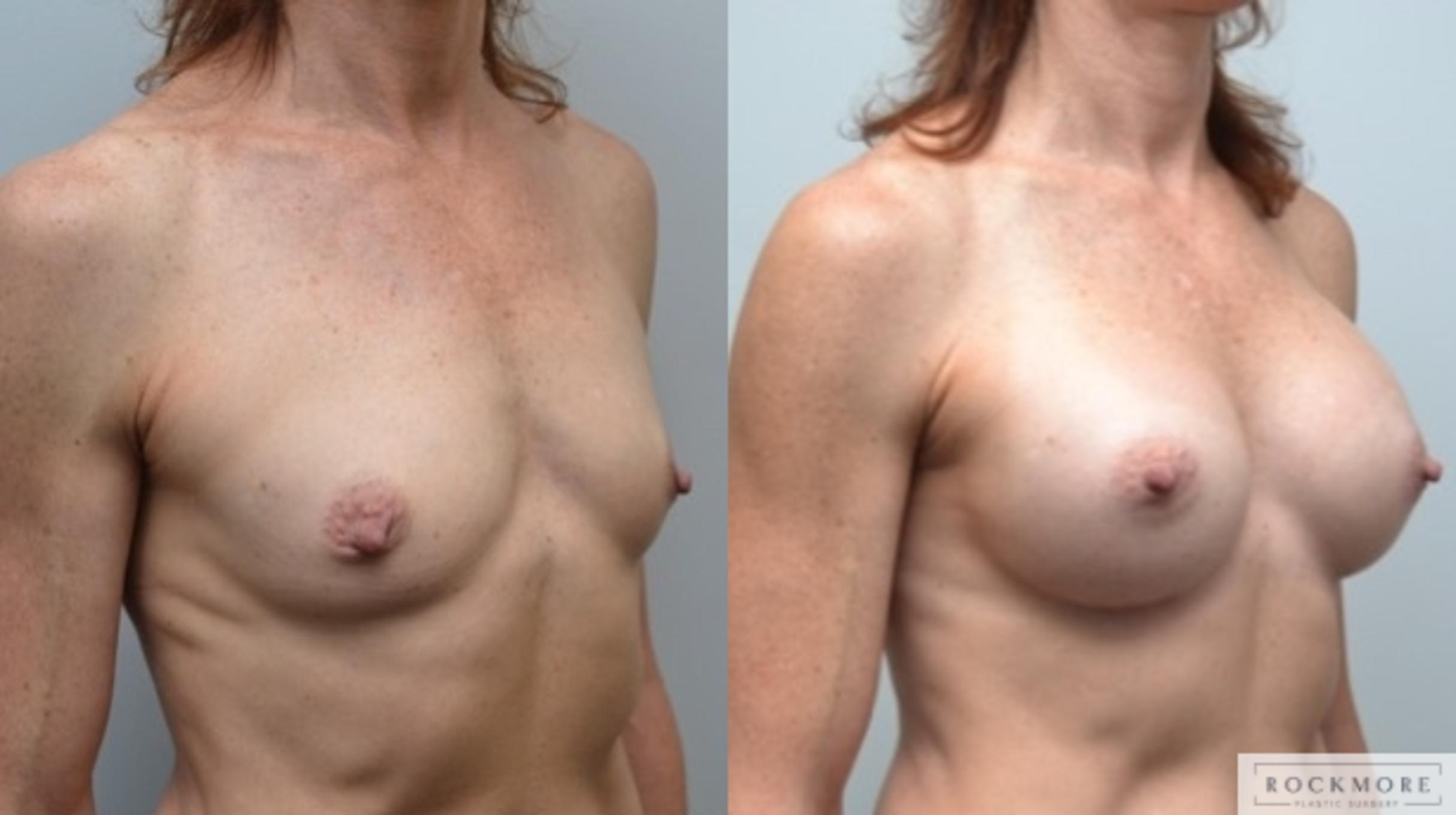 Before & After Breast Augmentation Case 243 View #4 View in Albany & Latham, New York