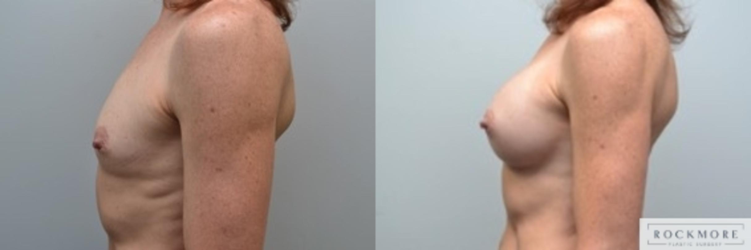 Before & After Breast Augmentation Case 243 View #5 View in Albany & Latham, New York
