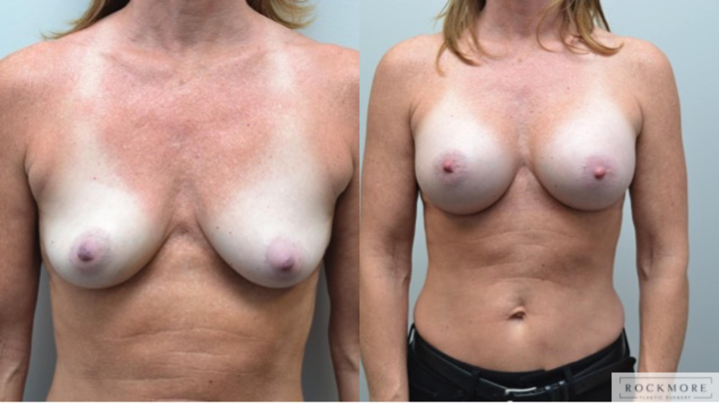 Before & After Breast Augmentation Case 244 View #1 View in Albany & Latham, New York