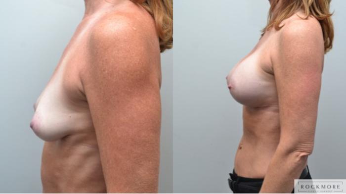 Before & After Breast Augmentation Case 244 View #2 View in Albany & Latham, New York