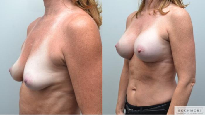 Before & After Breast Augmentation Case 244 View #3 View in Albany & Latham, New York