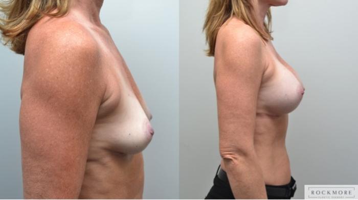 Before & After Breast Augmentation Case 244 View #4 View in Albany & Latham, New York