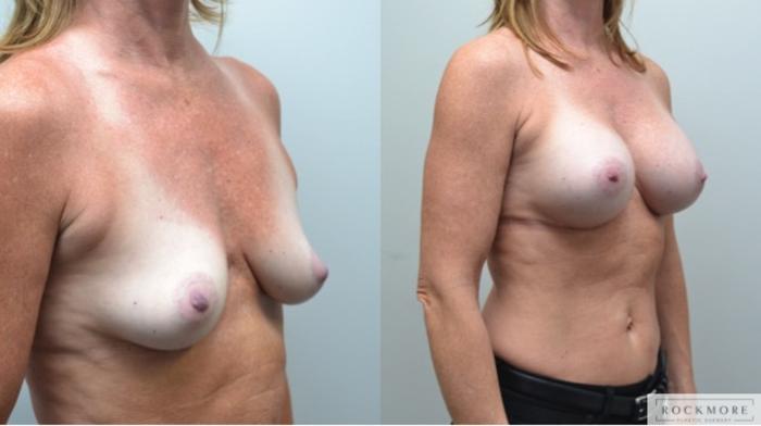 Before & After Breast Augmentation Case 244 View #5 View in Albany & Latham, New York