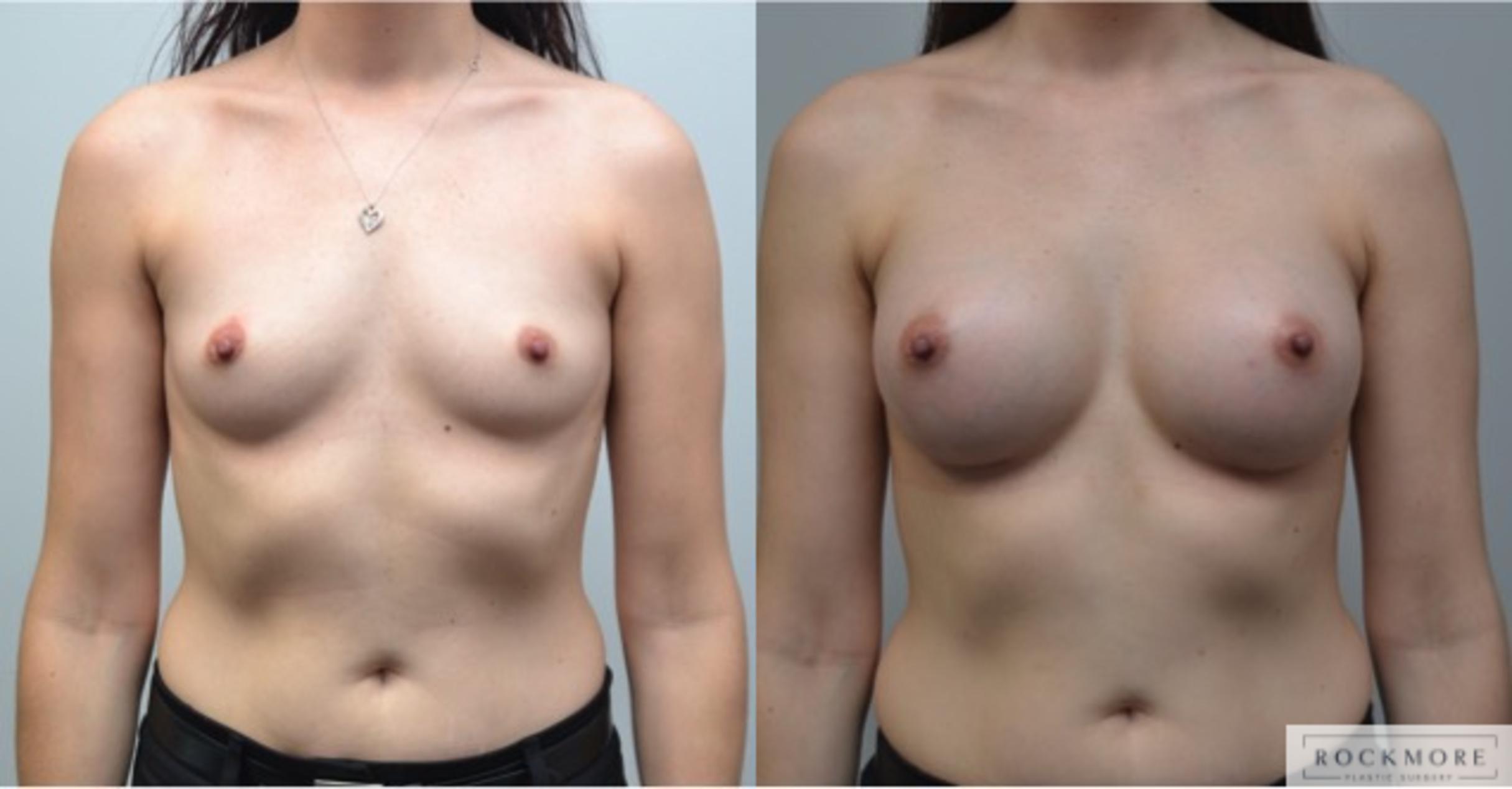 Before & After Breast Augmentation Case 249 View #1 View in Albany & Latham, New York