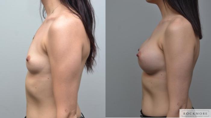 Before & After Breast Augmentation Case 249 View #2 View in Albany & Latham, New York