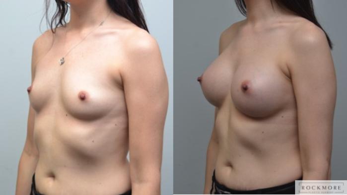 Before & After Breast Augmentation Case 249 View #3 View in Albany & Latham, New York